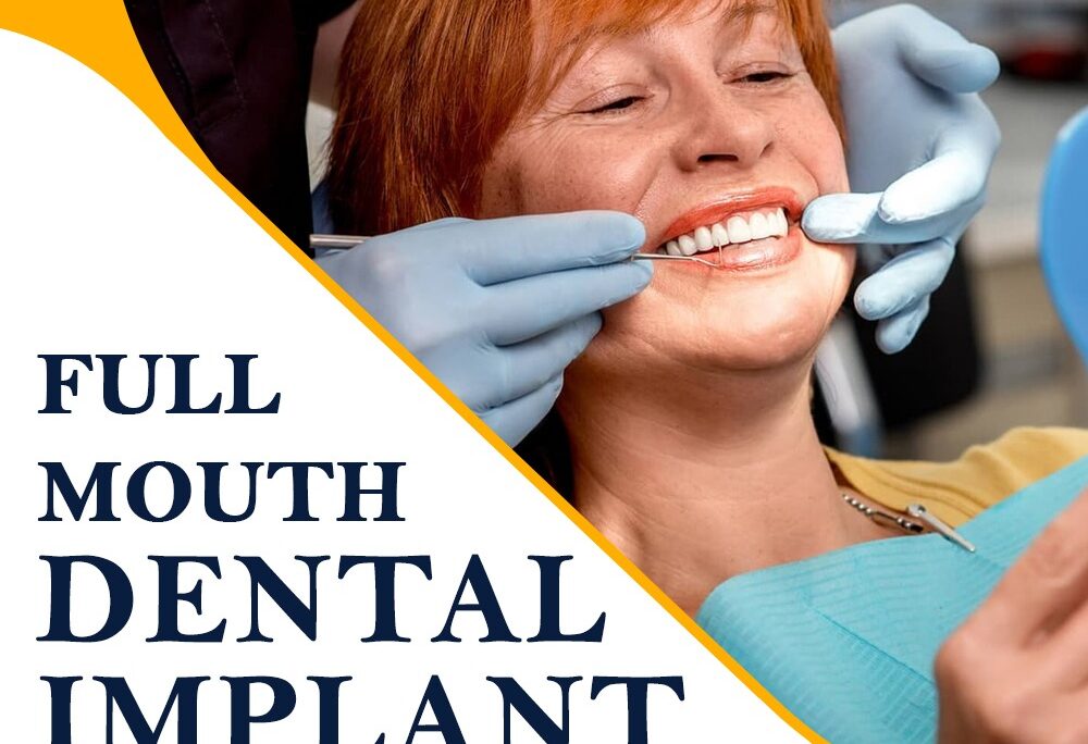 full mouth dental implant