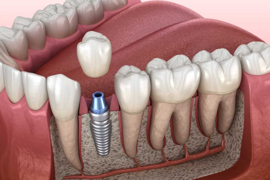Dental implant in mohali