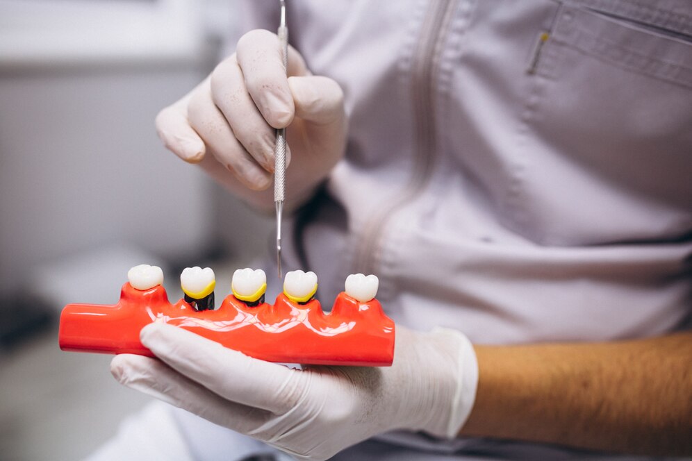 Multiple dental implants