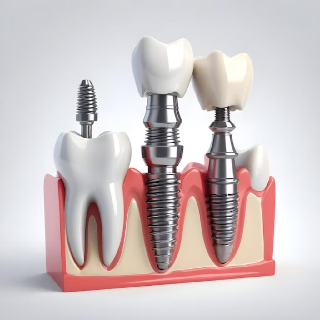 Best Dental Implant Clinic in Mohali