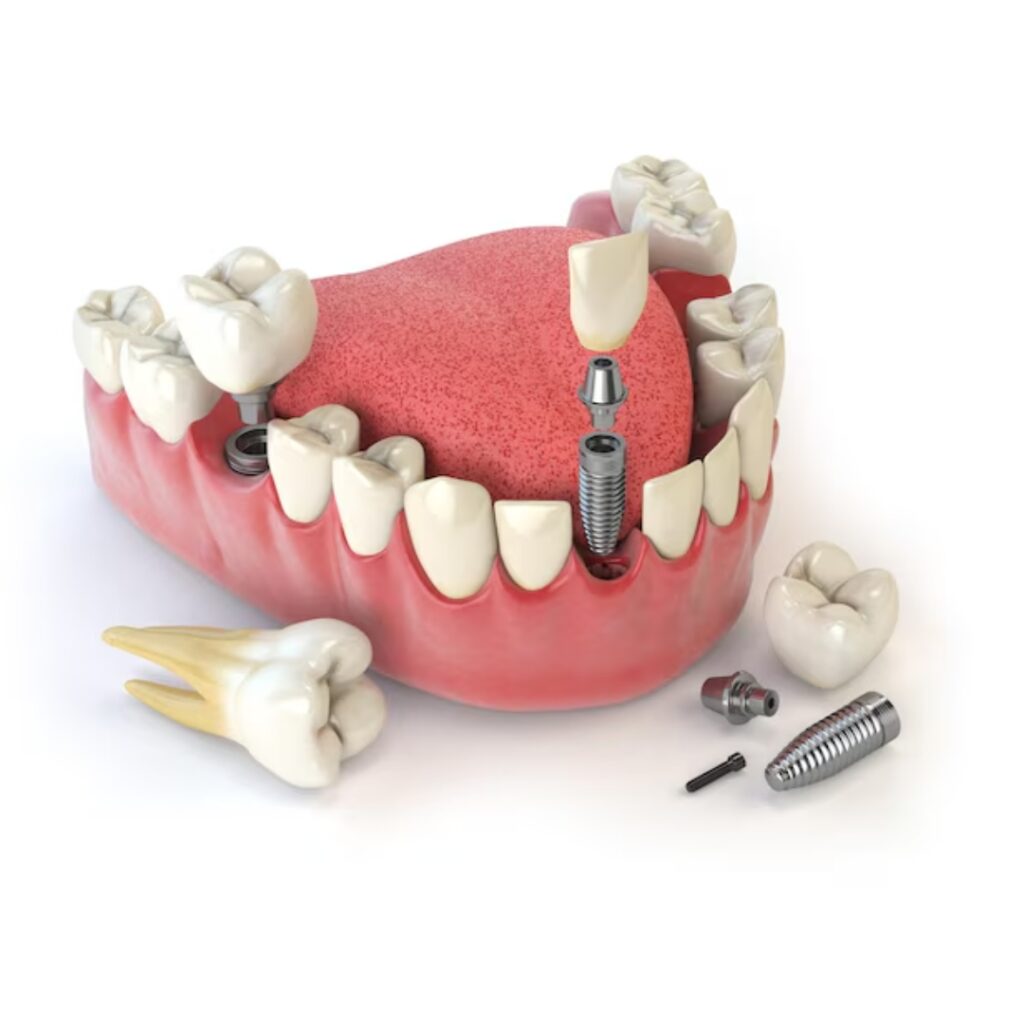 Cost of Dental Implants in Mohali