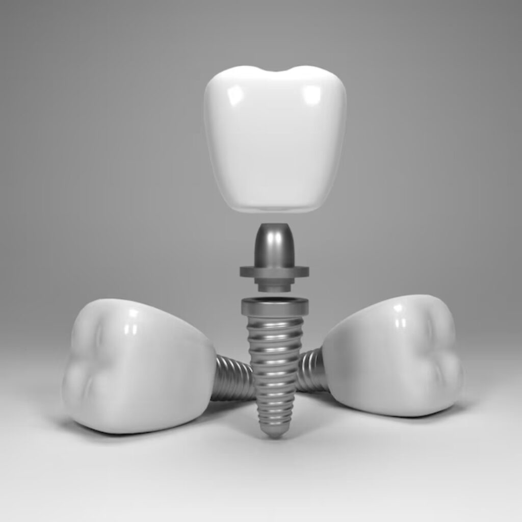 Dental Implant