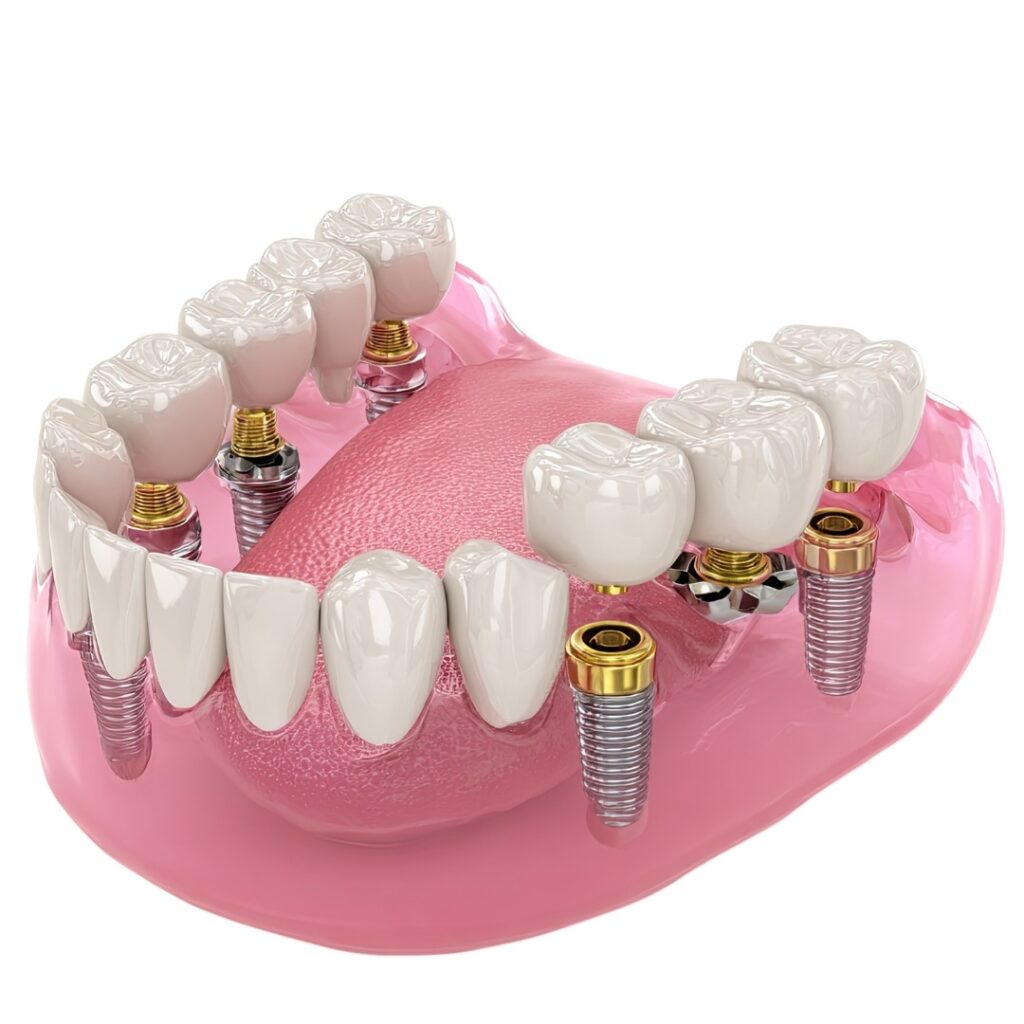 Affordable All on 4 Implants in India