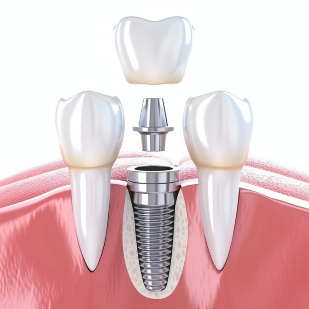 full mouth dental implants Chandigarh