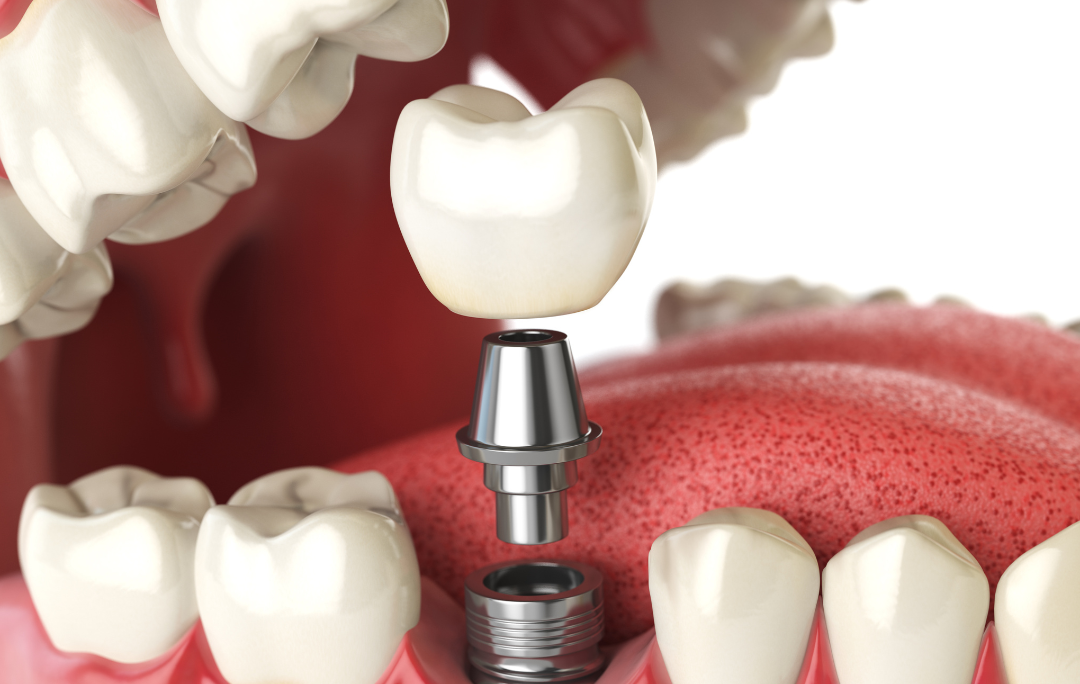 full mouth dental implants cost