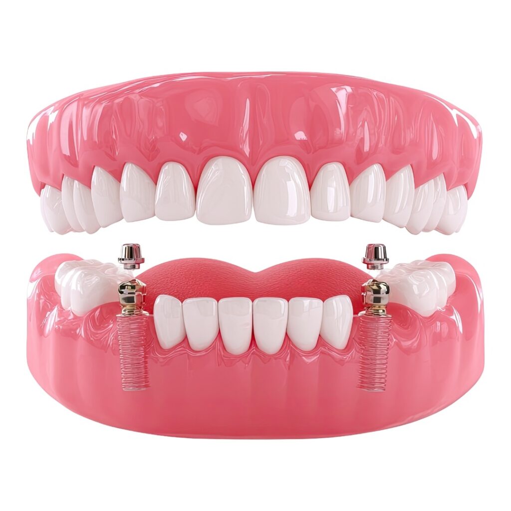 implant supported dentures Mohali