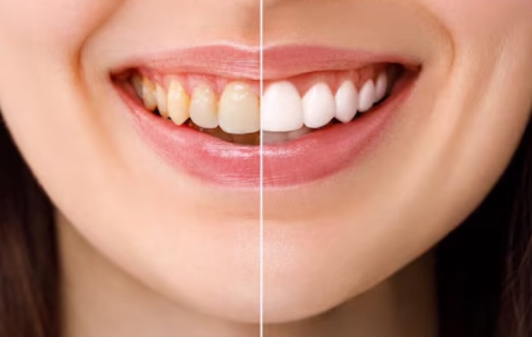 wisdom tooth removal cost