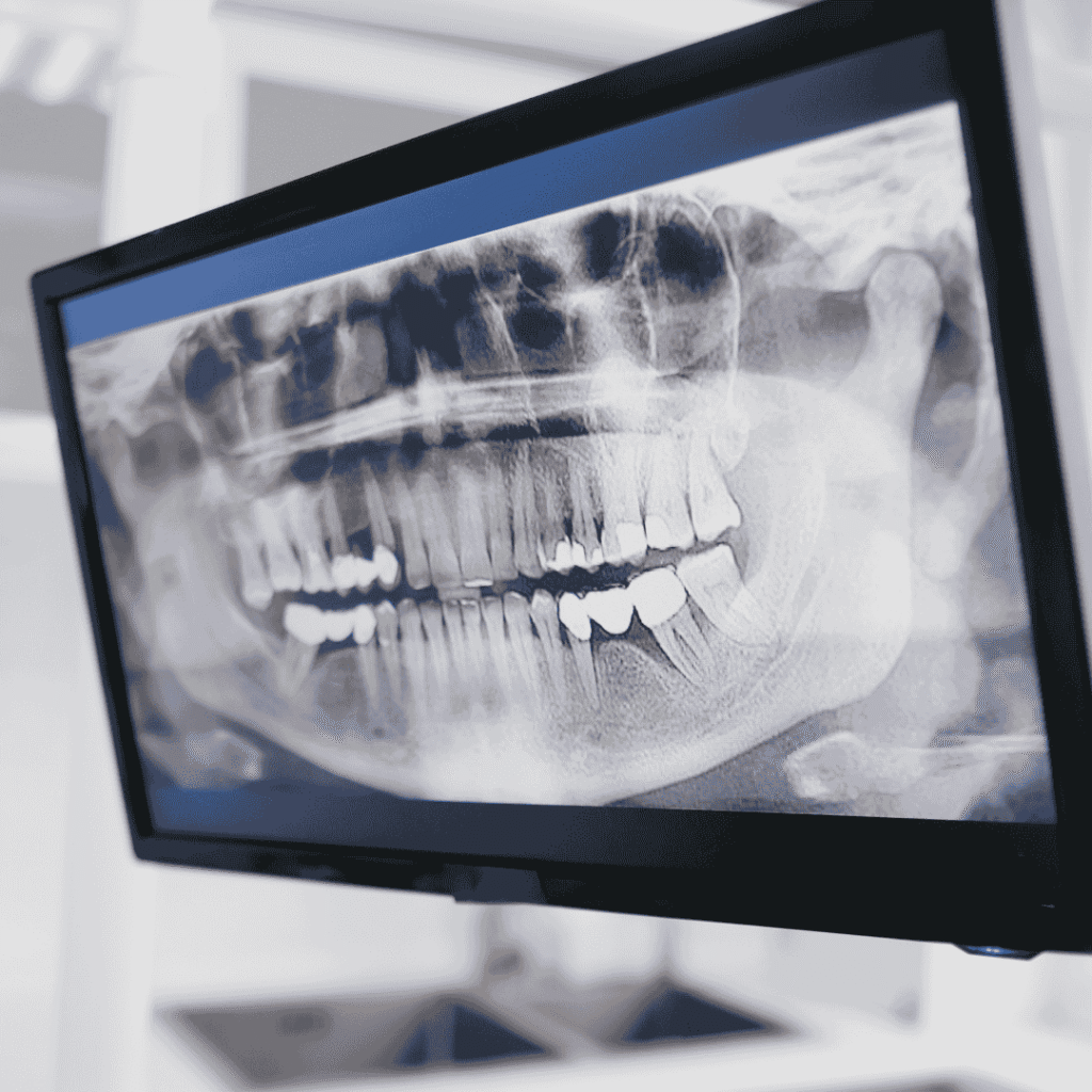 Full Mouth Dental Implants India