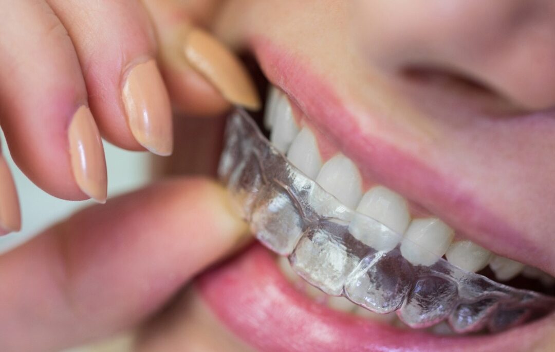 Metal Braces vs Ceramic Braces