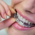 Metal Braces vs Ceramic Braces