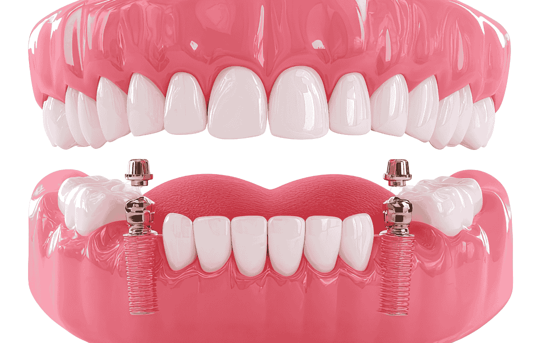 all-on-4 implant treatment