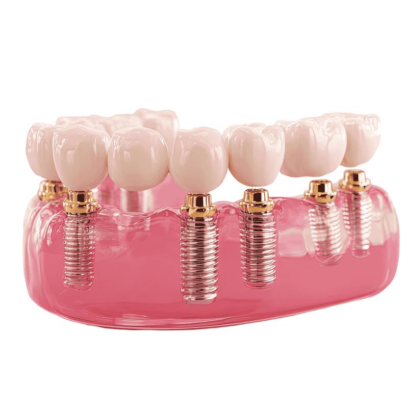 full mouth dental implants in Chandigarh