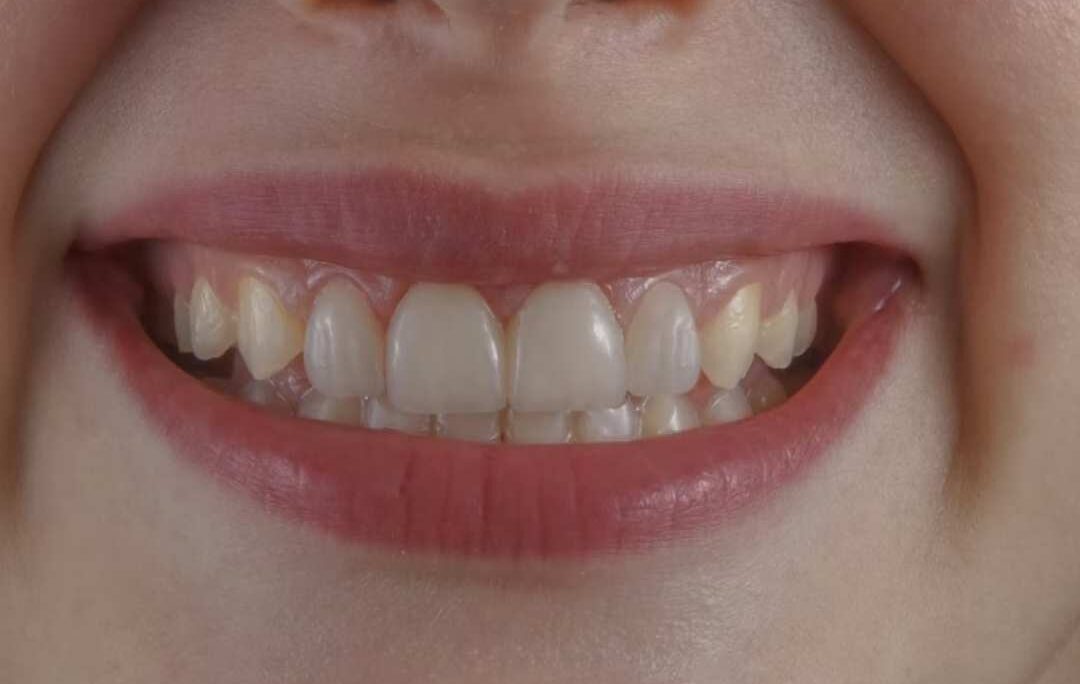 Laser teeth whitening in Chandigarh