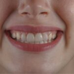 Laser teeth whitening in Chandigarh