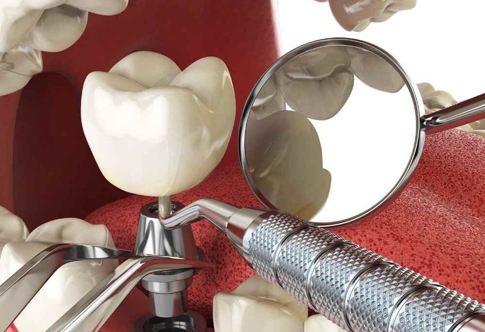 advanced implant surgical techniques Mumbai