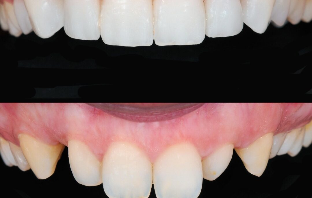 Smile Designing Cost in Mohali