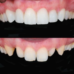 Smile Designing Cost in Mohali
