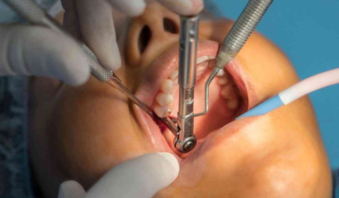 dental-implant