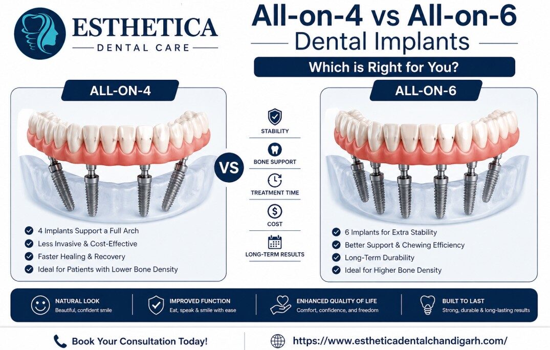All-on-4 vs All-on-6 Dental Implants