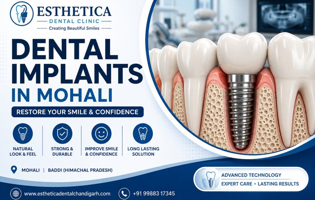 Dental Implants in Mohali