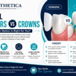 Dental Veneers vs Crowns
