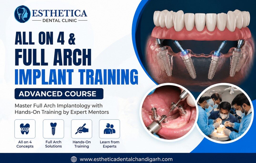 Full-arch implant