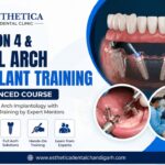 Full-arch implant