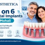 All on 6 Dental Implants in Mohali