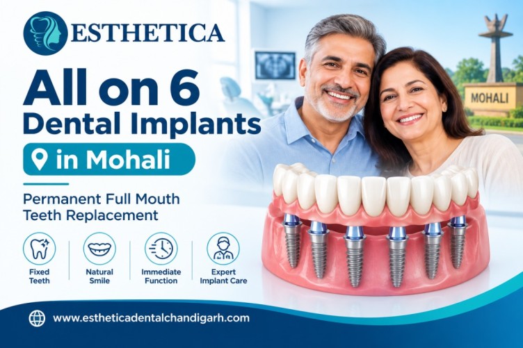 All on 6 Dental Implants in Mohali